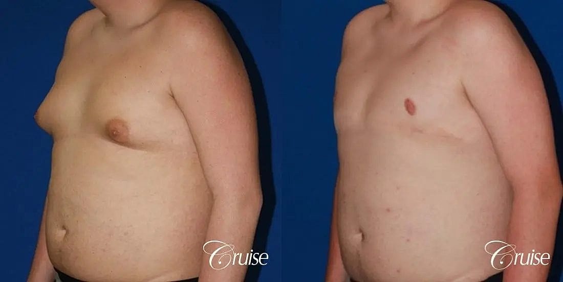 Gynecomastia Before & After