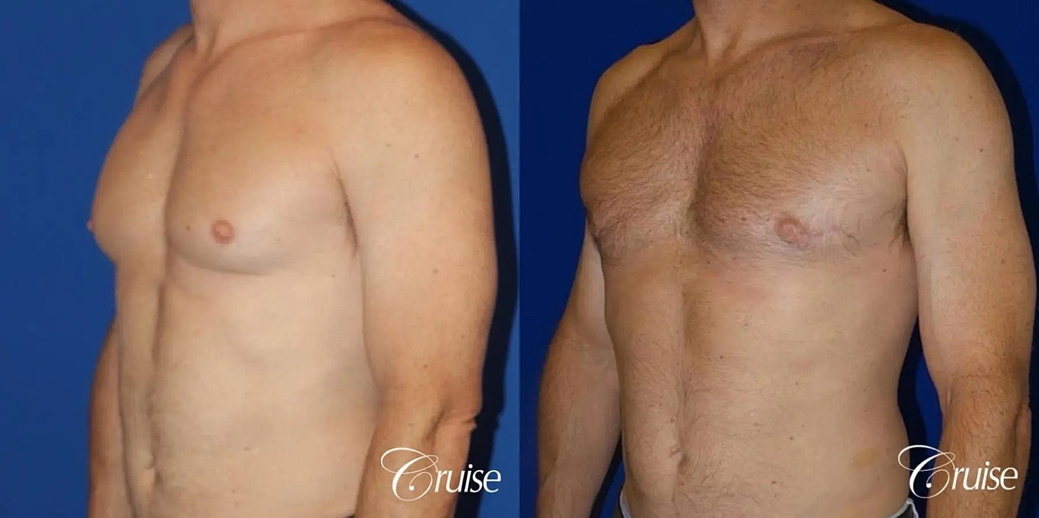 Gynecomastia Before & After