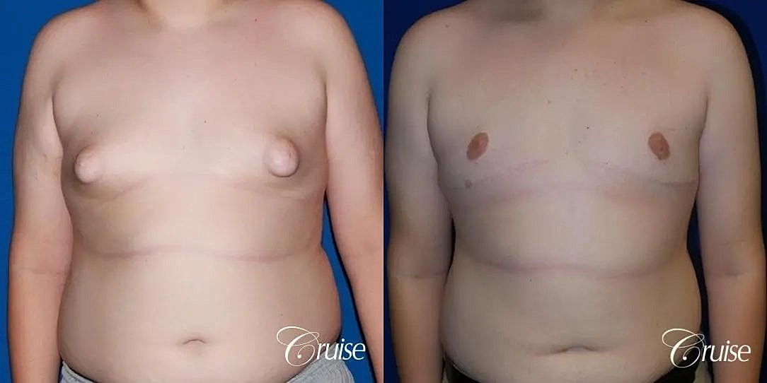 Gynecomastia Before & After