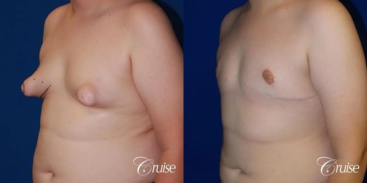 Gynecomastia Before & After