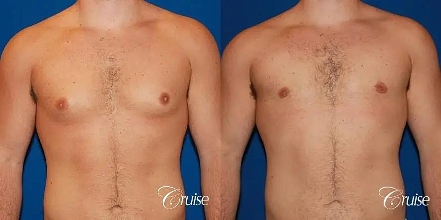 Gynecomastia Before & After