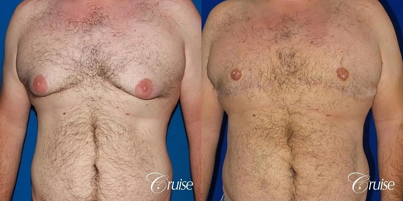 Gynecomastia Before & After
