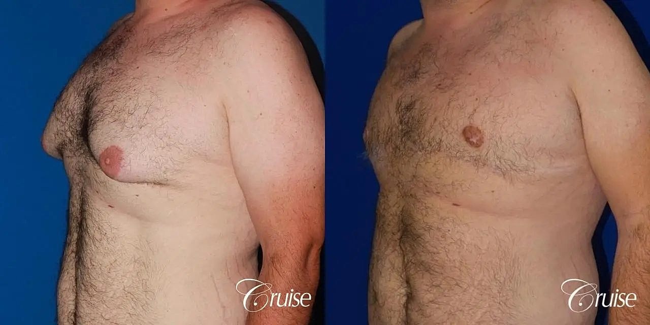 Gynecomastia Before & After