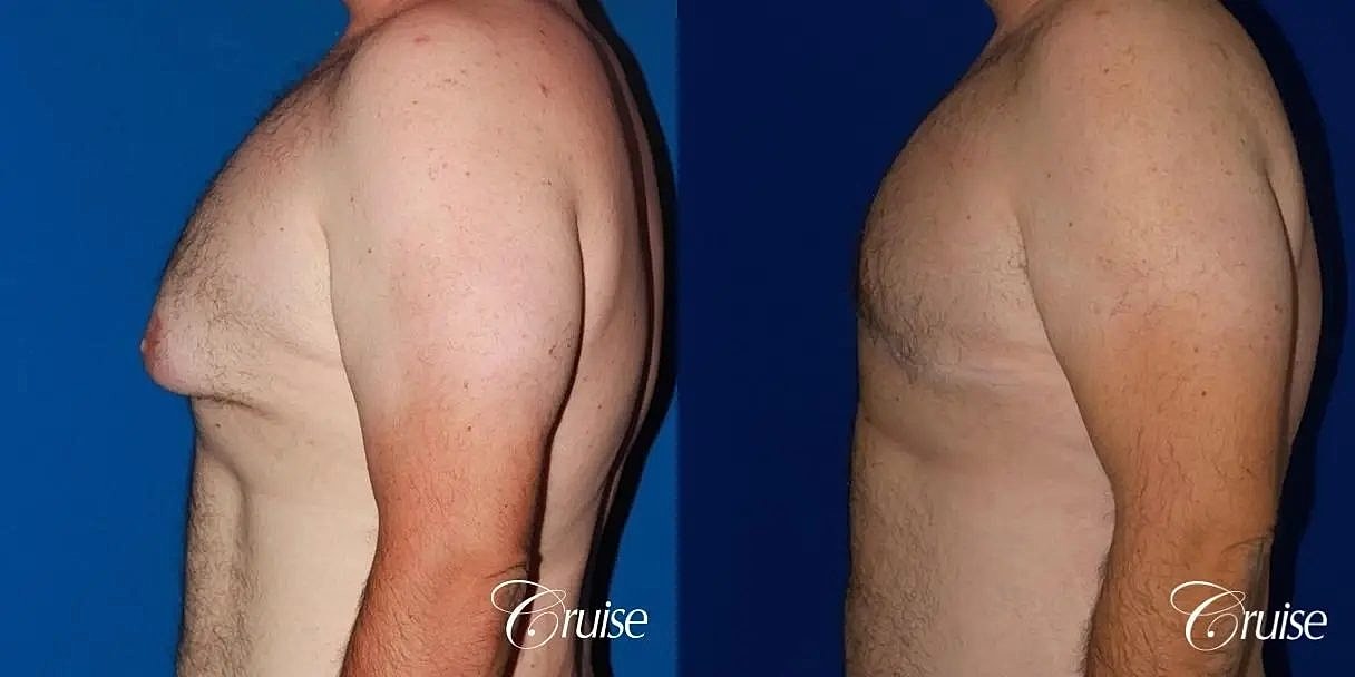 Gynecomastia Before & After