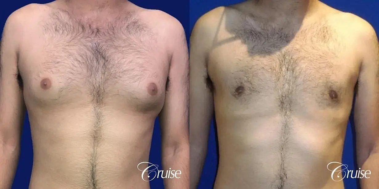 Gynecomastia Before & After