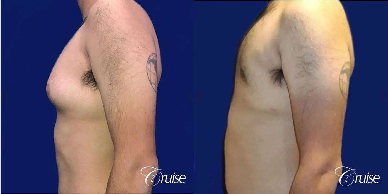 Gynecomastia Before & After