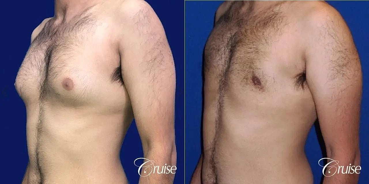 Gynecomastia Before & After