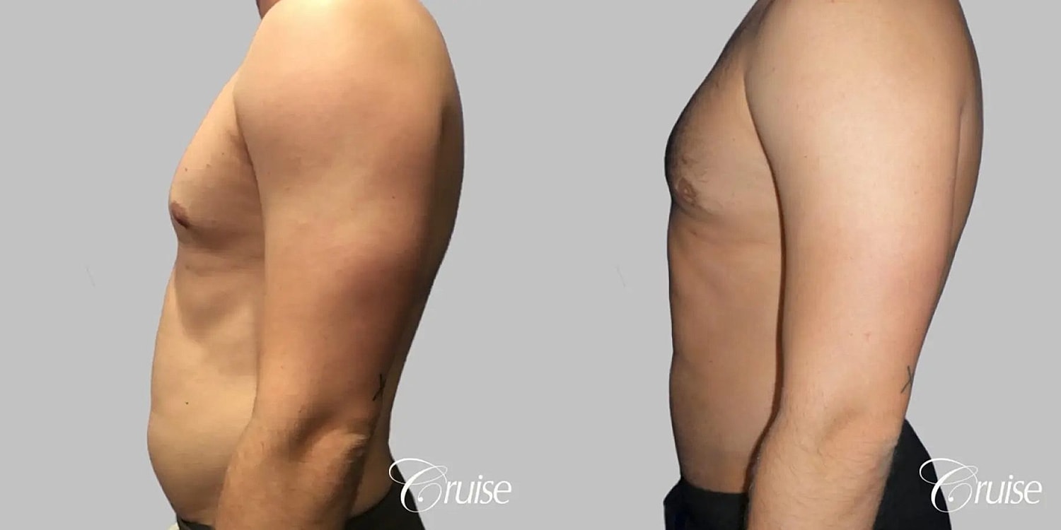 Gynecomastia Before & After