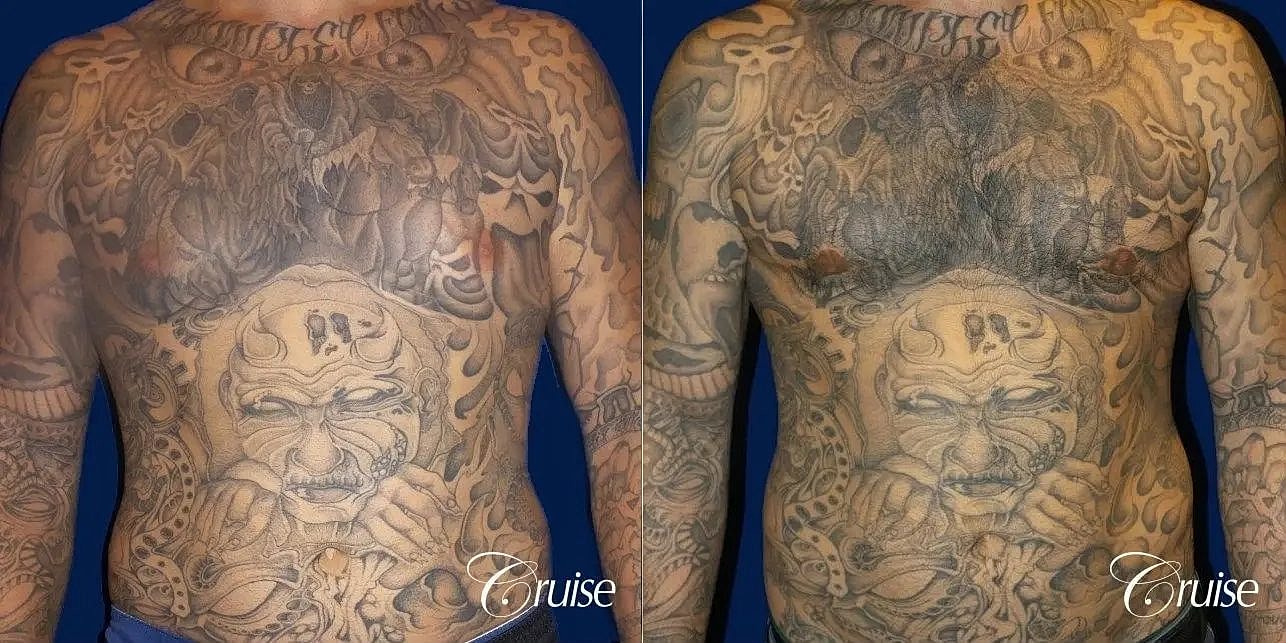 Gynecomastia Before & After