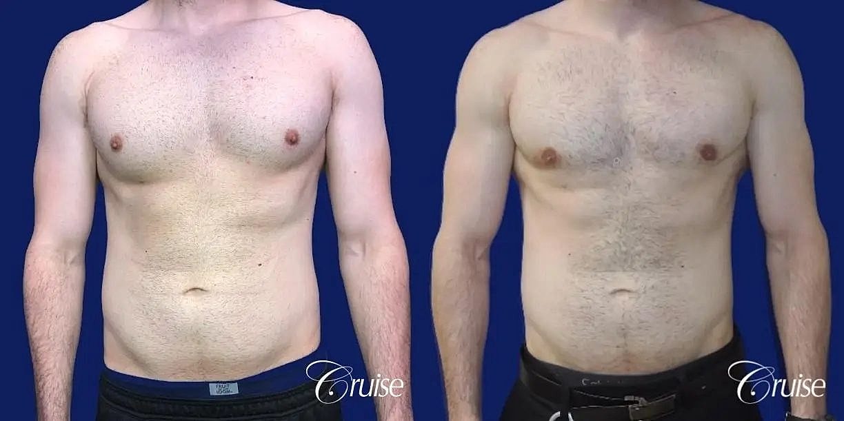 Gynecomastia Before & After