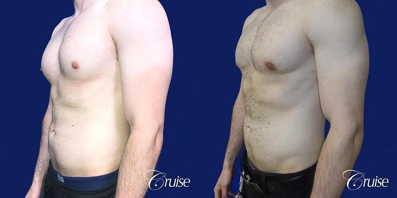 Gynecomastia Before & After