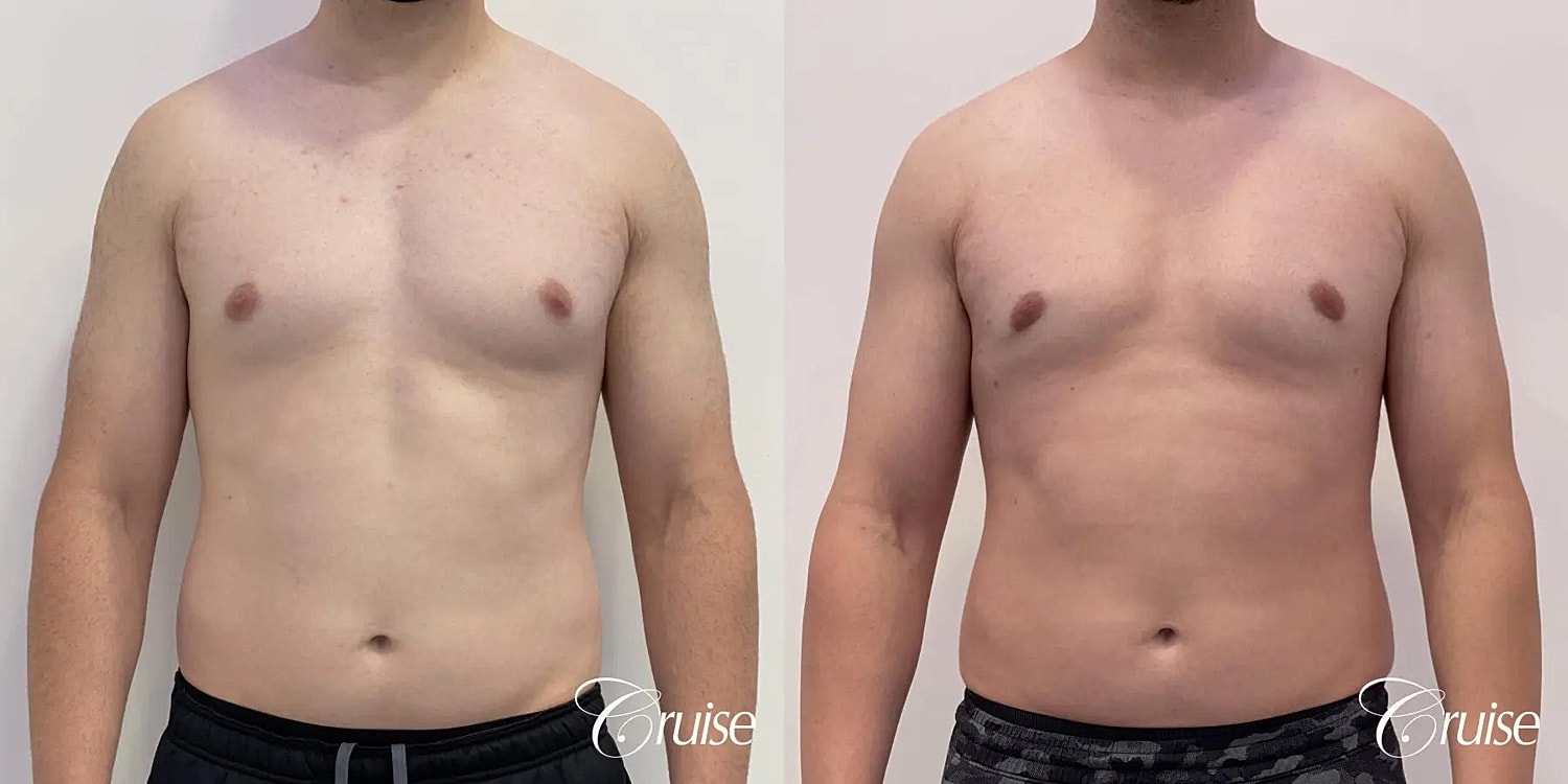 Gynecomastia Before & After