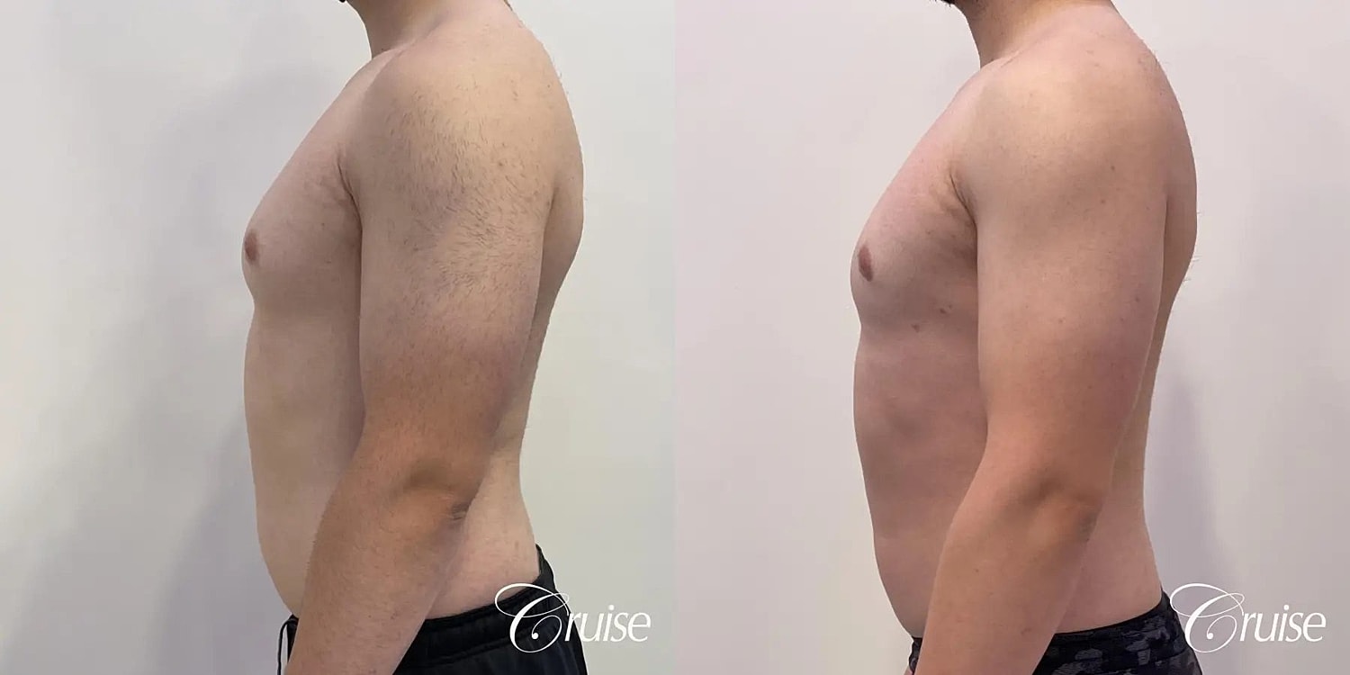 Gynecomastia Before & After