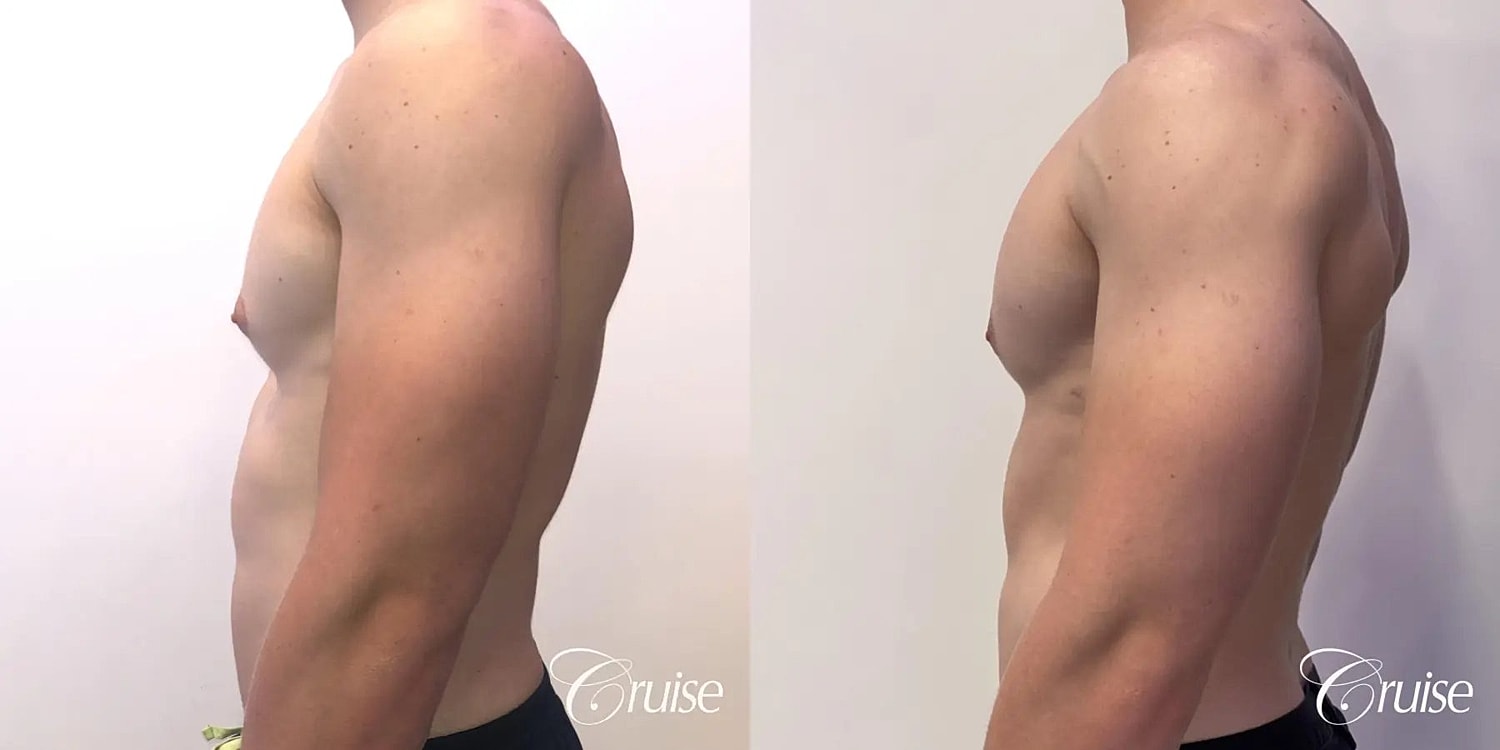 Gynecomastia Before & After