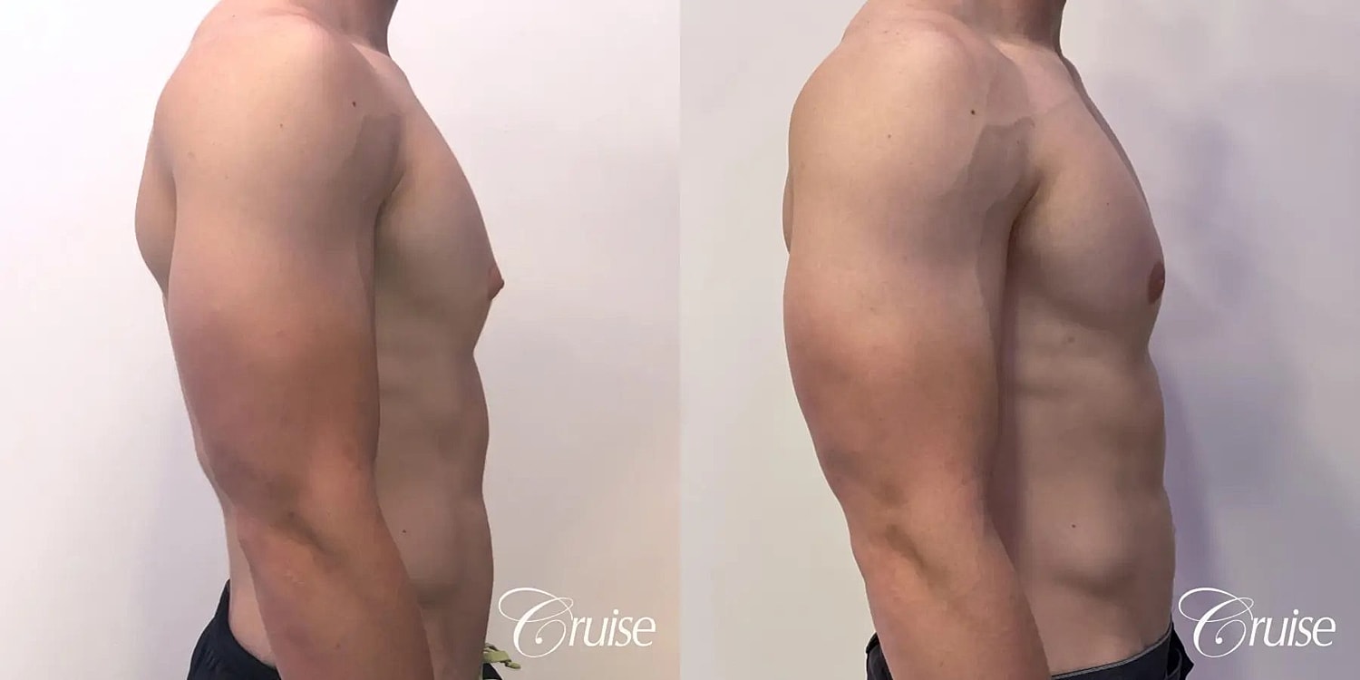 Gynecomastia Before & After