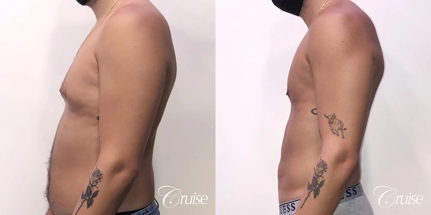Gynecomastia Before & After