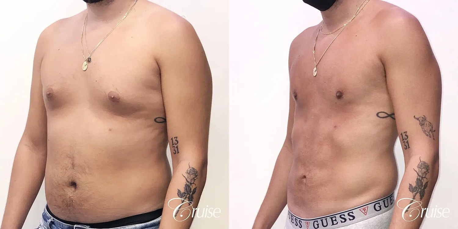 Gynecomastia Before & After