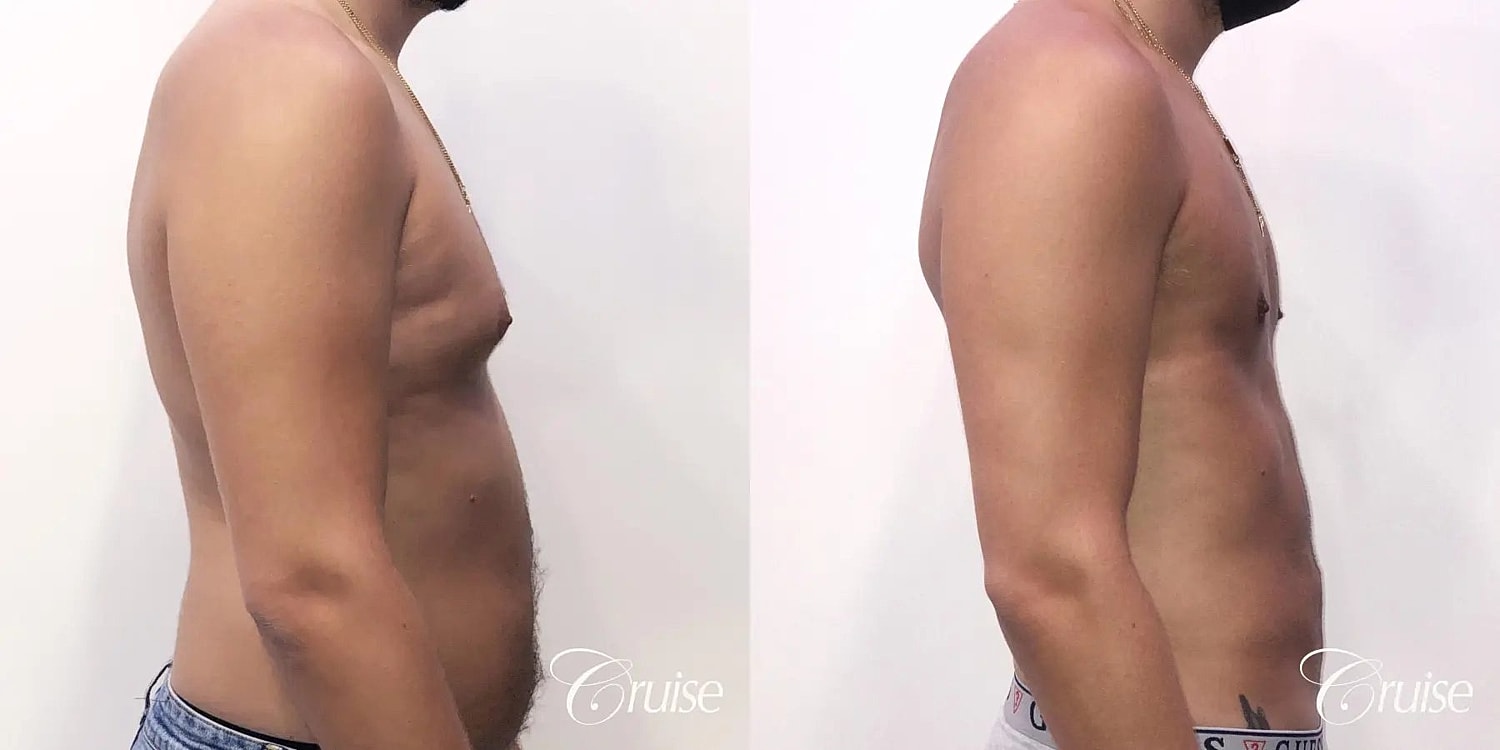 Gynecomastia Before & After