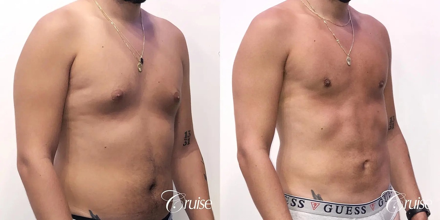 Gynecomastia Before & After
