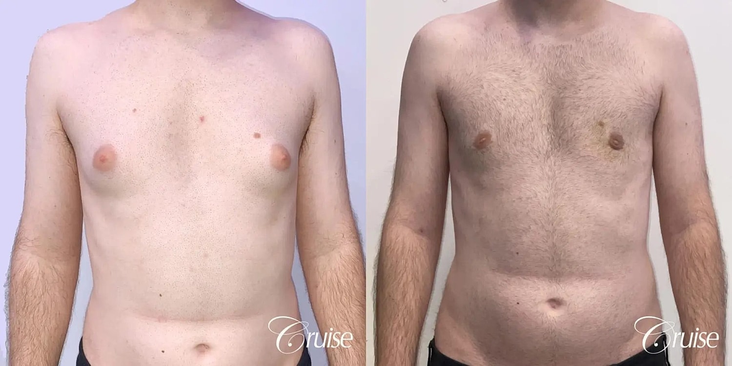 Gynecomastia Before & After