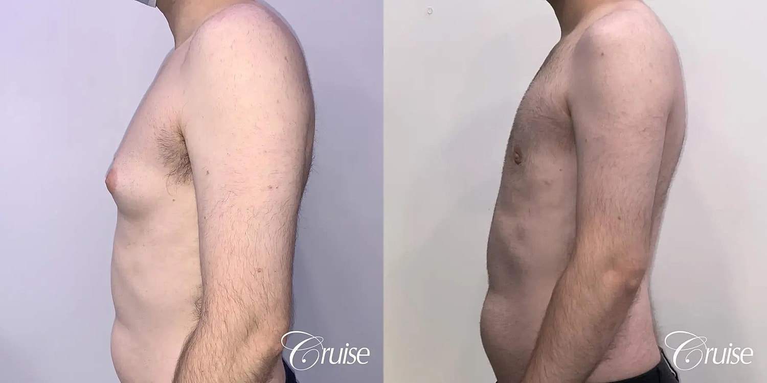 Gynecomastia Before & After