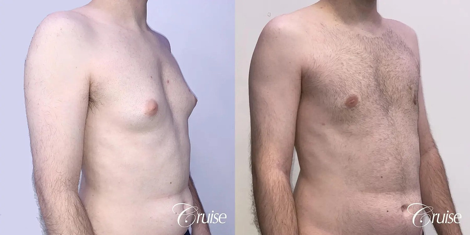 Gynecomastia Before & After