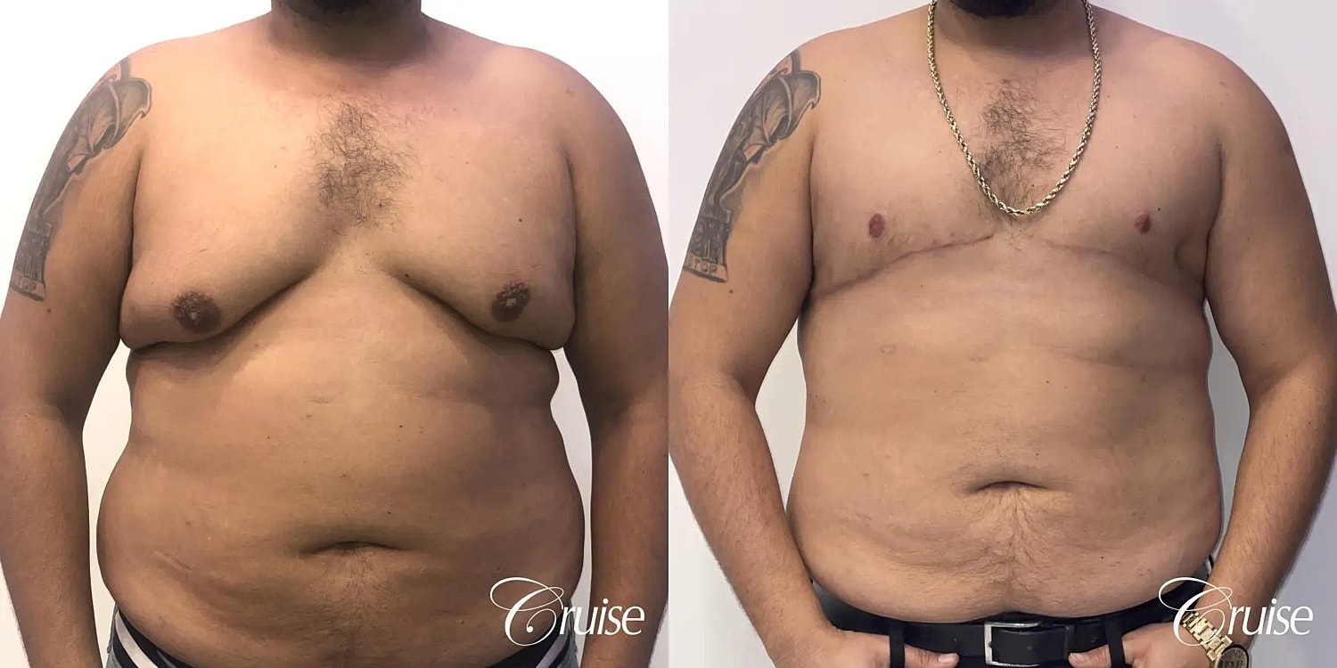 Gynecomastia Before & After