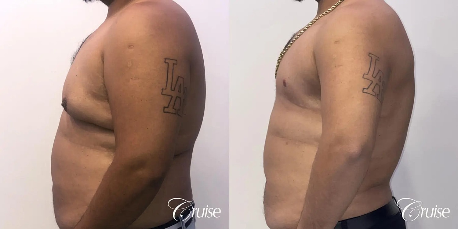 Gynecomastia Before & After