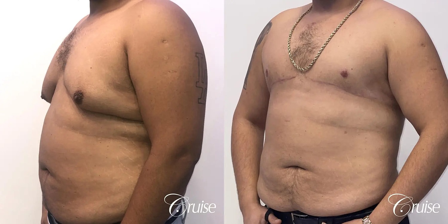 Gynecomastia Before & After