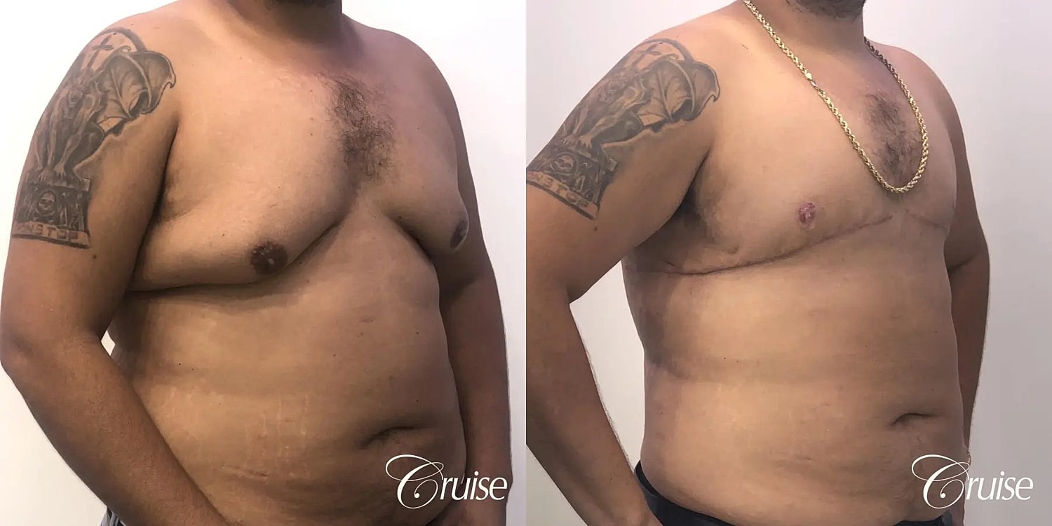 Gynecomastia Before & After