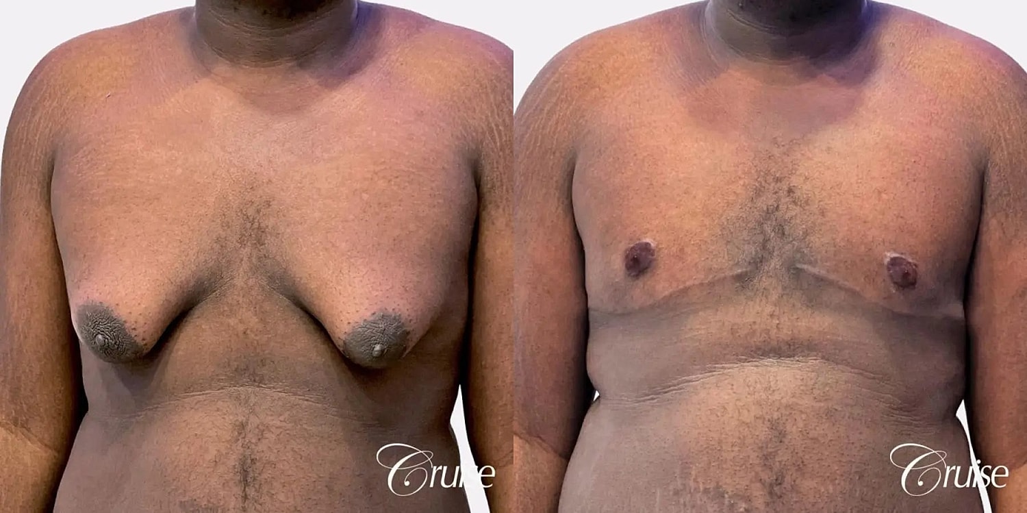 Gynecomastia Before & After