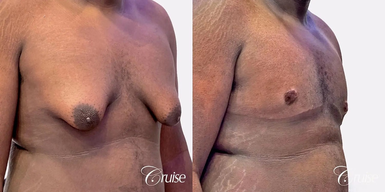 Gynecomastia Before & After