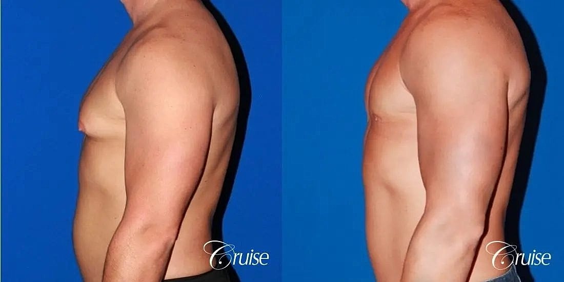 Gynecomastia Before & After