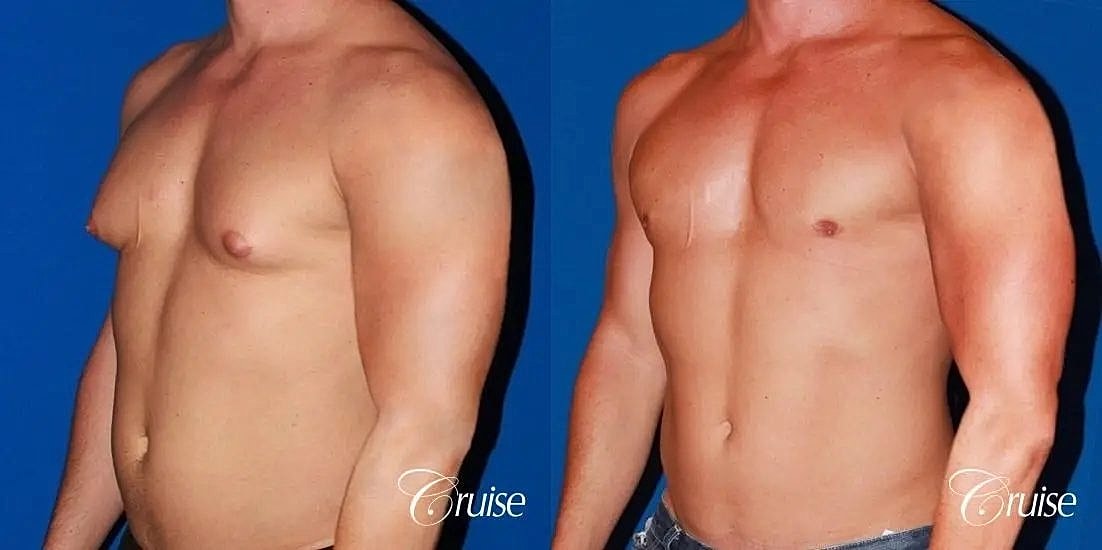 Gynecomastia Before & After