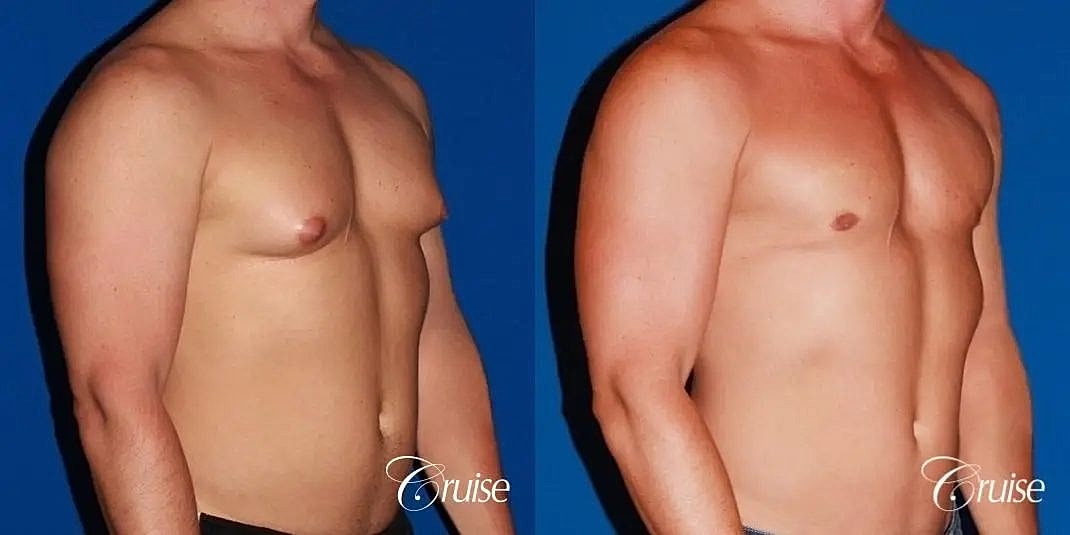 Gynecomastia Before & After