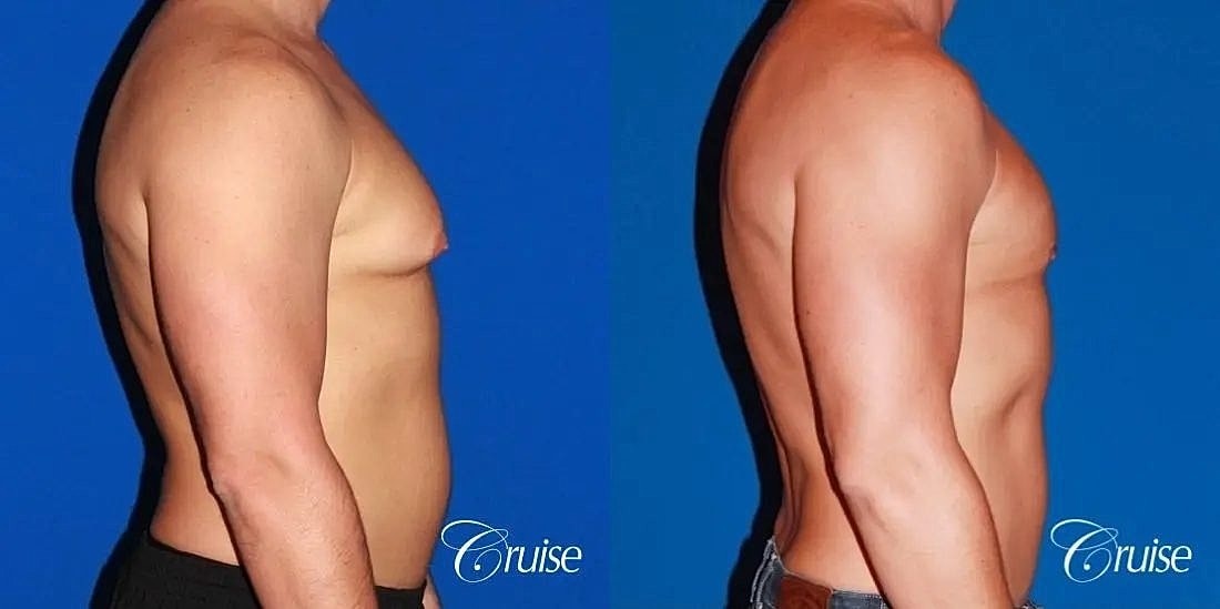 Gynecomastia Before & After