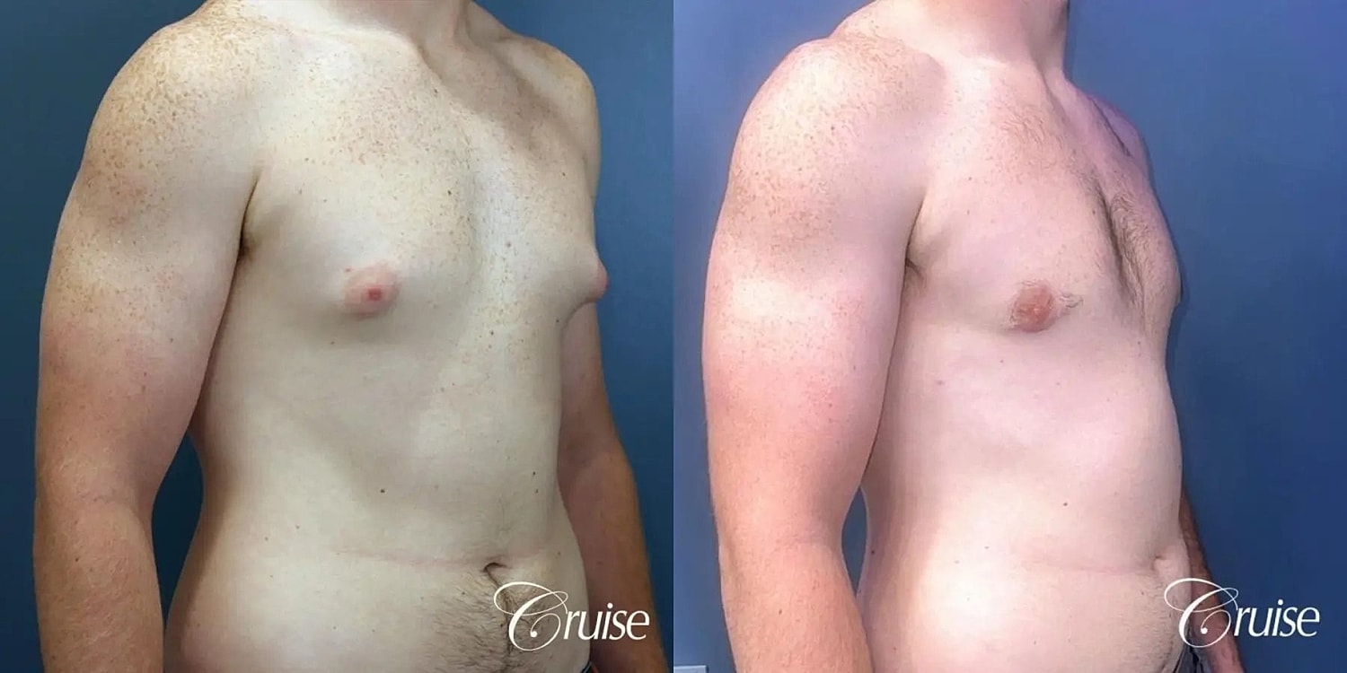Gynecomastia Before & After