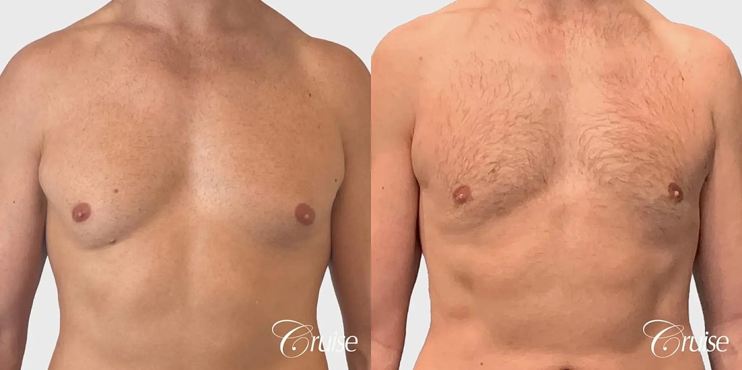 Gynecomastia Before & After