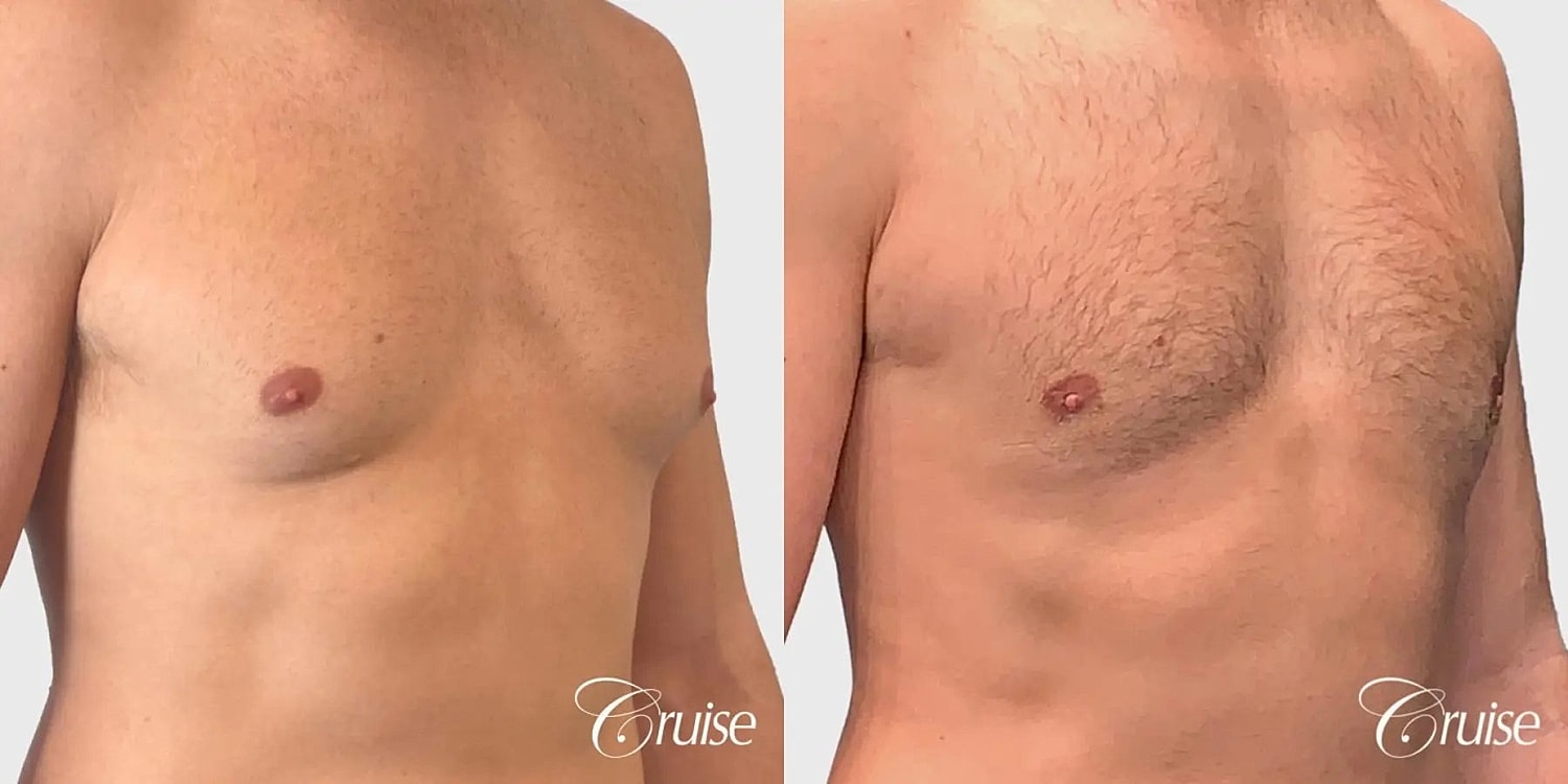 Gynecomastia Before & After