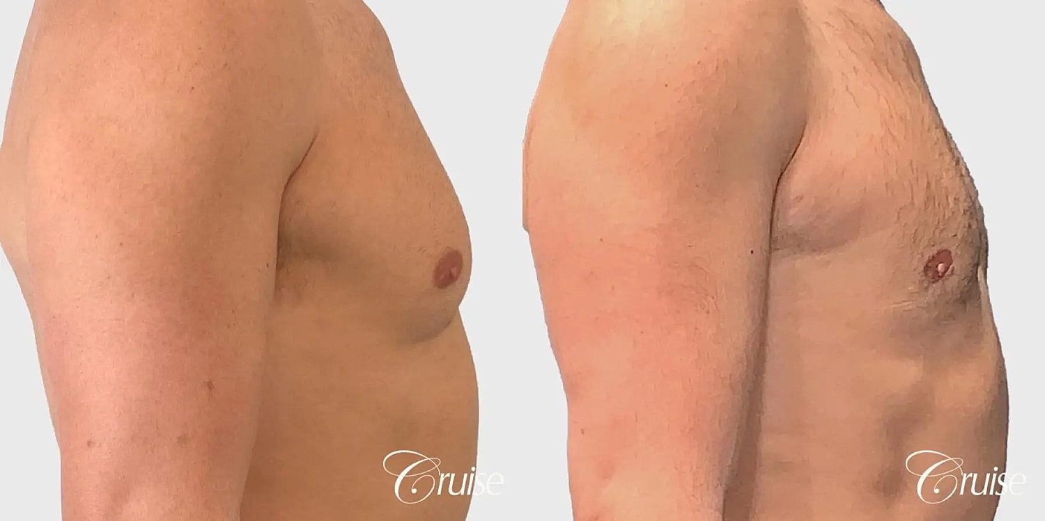 Gynecomastia Before & After