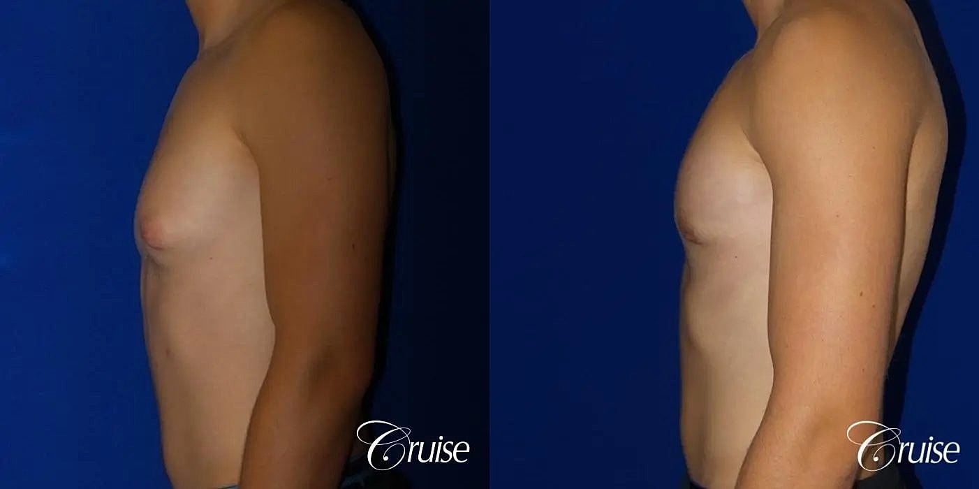 Gynecomastia Before & After
