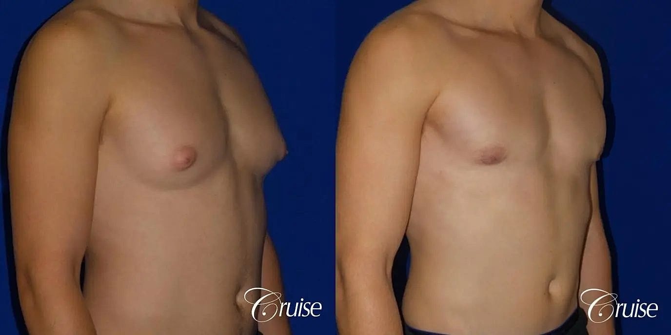 Gynecomastia Before & After