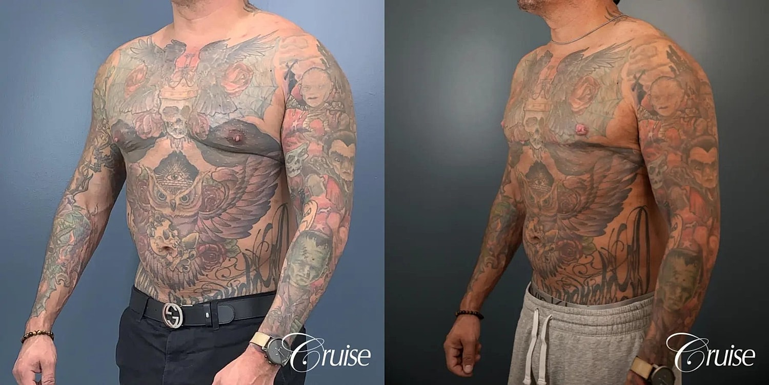 Gynecomastia Before & After