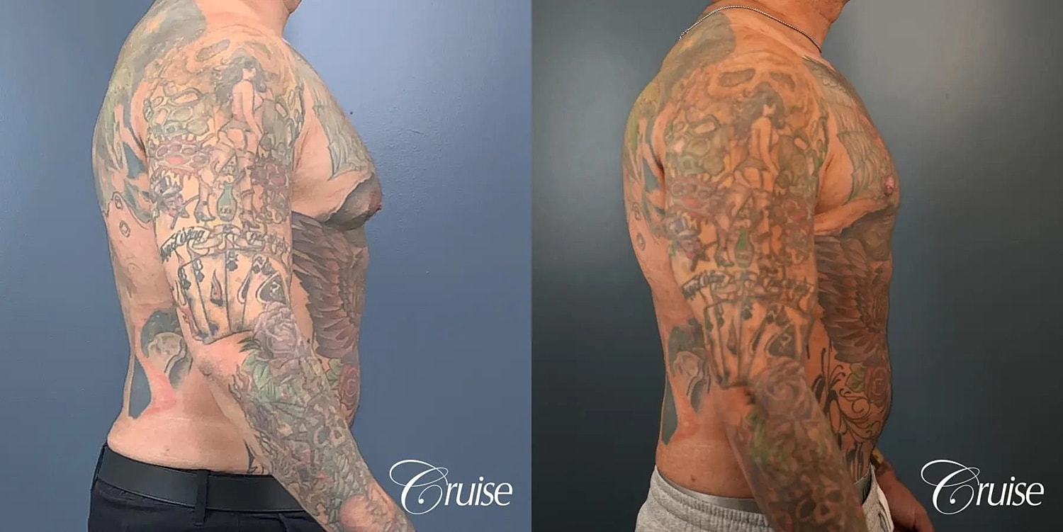 Gynecomastia Before & After