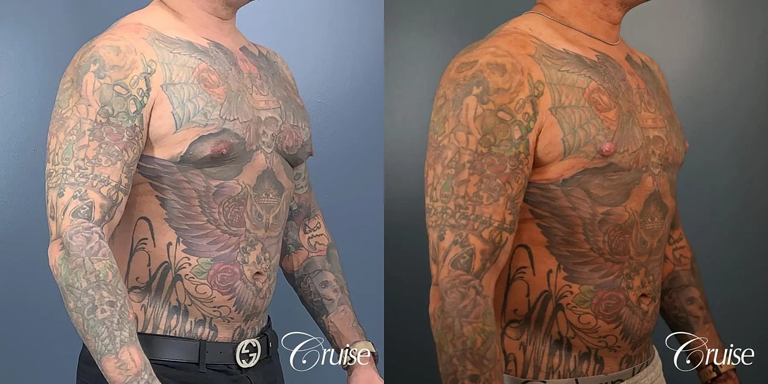 Gynecomastia Before & After