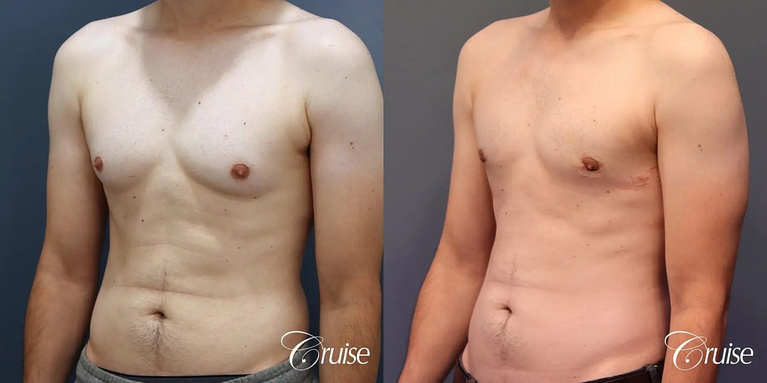 Gynecomastia Before & After