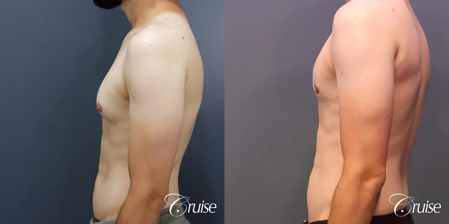 Gynecomastia Before & After