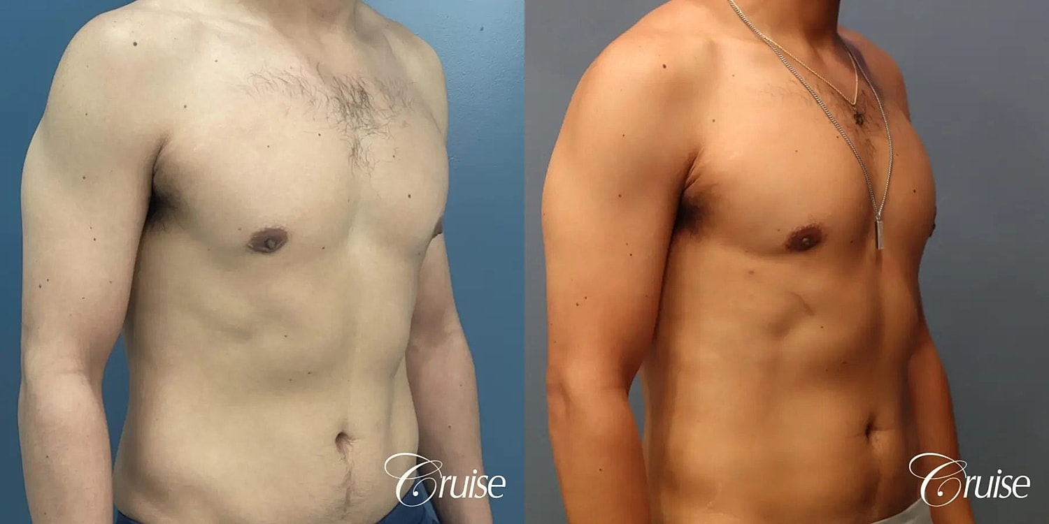 Gynecomastia Before & After