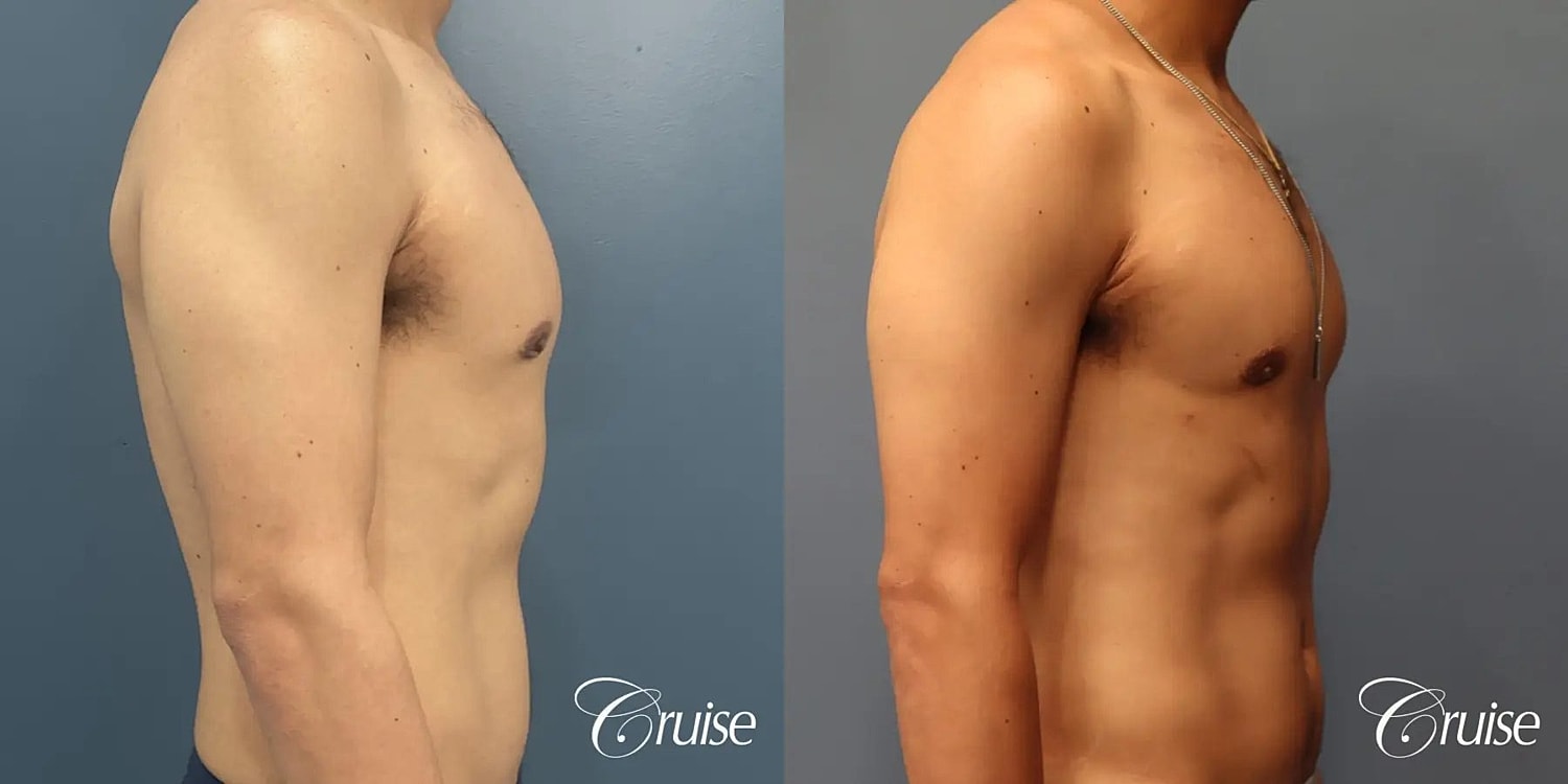 Gynecomastia Before & After