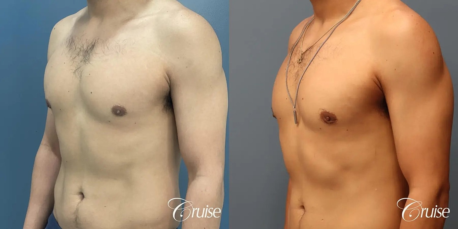 Gynecomastia Before & After